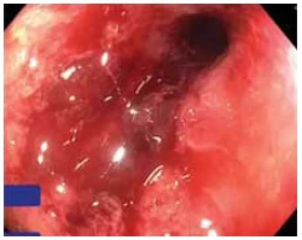 An early colonoscopy, which showed
tight fi liform stenosis of the sigmoid
that was not permeable to the
endoscope. <br> 
Obr. 3. Časná koloskopie, která prokázala
těsnou filiformní stenózu sigmatu neprostupnou
pro endoskop.