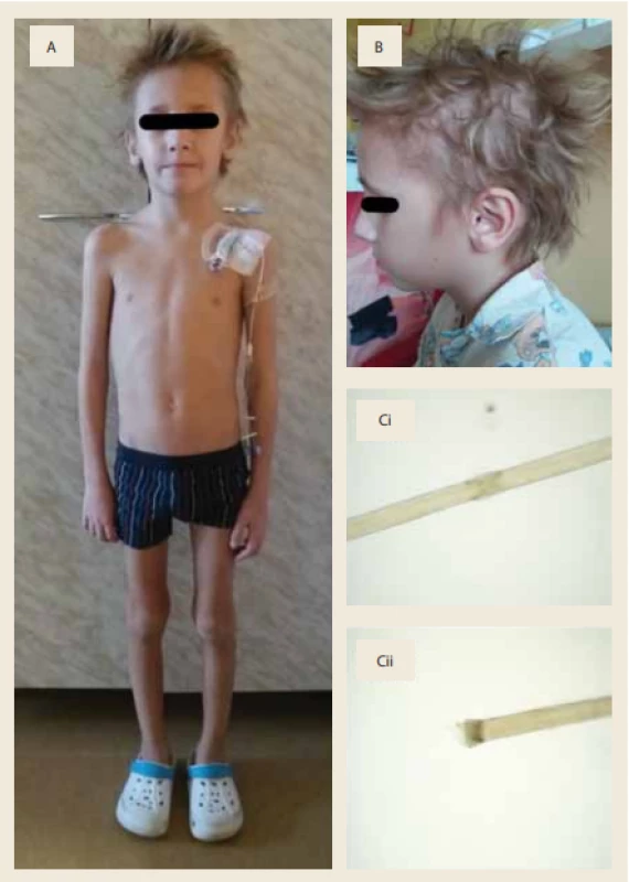 Clinical data of the patient.<br>
A – Overall habitus of the patient. B – Detail of the hairy part of the head. Brittle, easily
breakable hair. Ci – Hair analysis using light microscopy showing trichorrhexis nodosa.
Magnifi cation 40×. Cii – Bristly split hair ends. Magnifi cation 40×.
Obr. 1. Klinická data pacienta.<br>
A – Celkový habitus pacienta. B – Detail vlasaté části hlavy. Křehké, snadno lomivé
vlasy. Ci – Analýza vlasu pomocí světelného mikroskopu. Trichorrhexis nodosa. Zvětšení 40×. Cii – Roztřepené štětkovité konečky vlasů. Zvětšení 40×. 