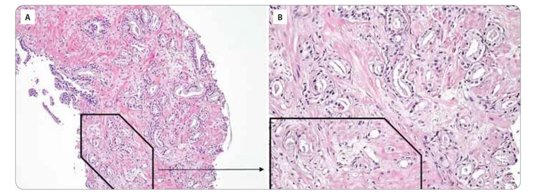 Histologické vyšetření prostaty se semennými váčky prokazující přítomnost acinárního adenokarcinomu prostaty.<br>
Acinární adenokarcinom prostaty, Gleason skóre 7 (3 + 4), grade group 2: převažují izolované nádorové žlázky variabilní velikosti
(Gleason pattern 3) a špatně formované až naznačeně fúzující žlázky (Gleason pattern 4 – černý rámeček). A) Zvětšení 100x; B) zvětšení
200x.