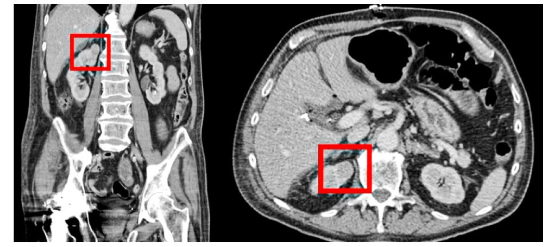 CT prokazující solidní ložisko horního pólu pravé ledviny (Zdroj: archiv Kliniky radiologie a nukleární
medicíny Fakultní nemocnice Brno)<br>
Fig. 1. Abdominal CT scan demonstrating a solid mass of the upper pole of the right kidney (from the archive
of Department of Radiology and Nuclear Medicine, University Hospital Brno)