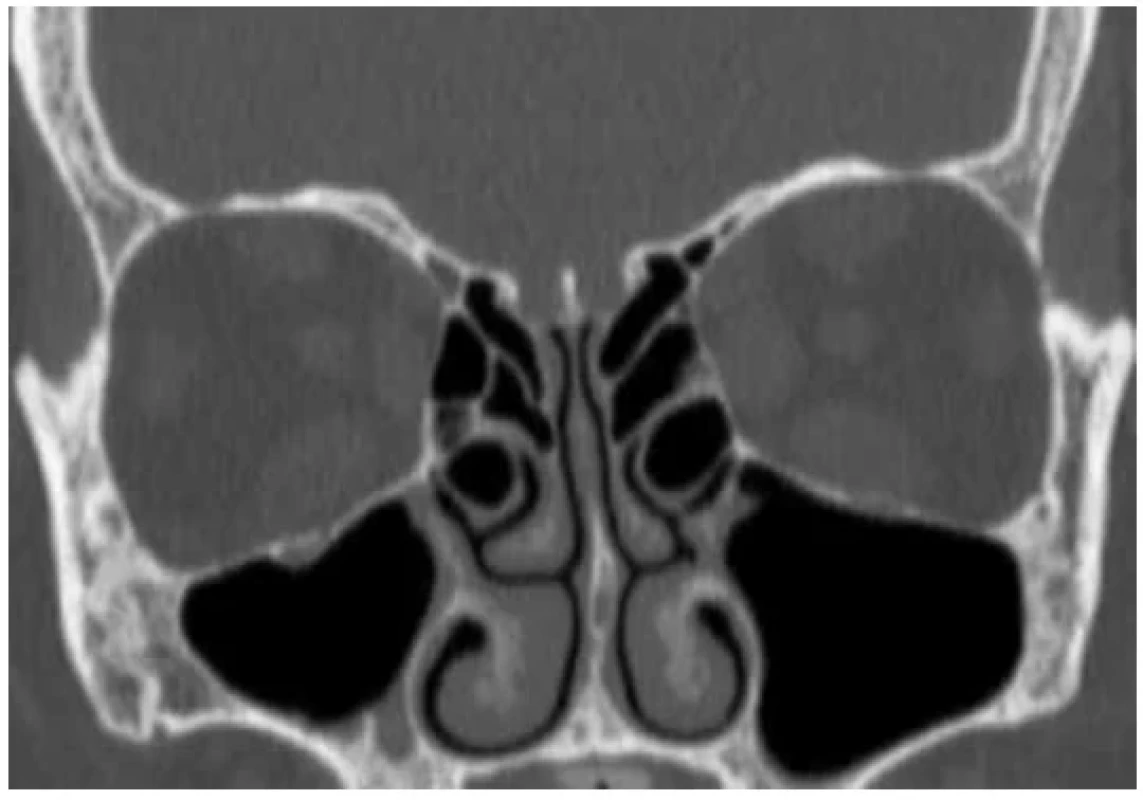 Computer tomography –finding before decompression of orbit, excellent depiction
of bone structures
