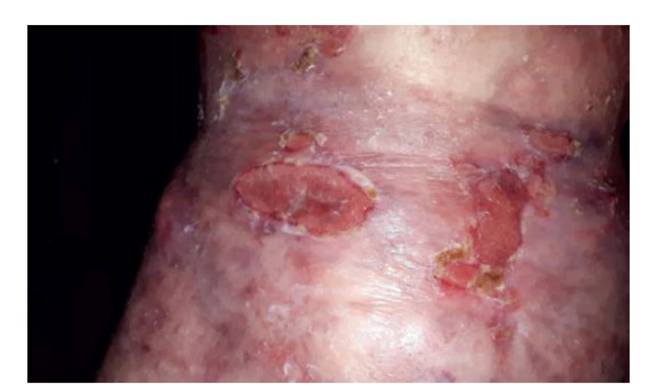 Výsledný stav po chirurgických intervencích<br>
Fig. 6: Final condition after surgical procedures