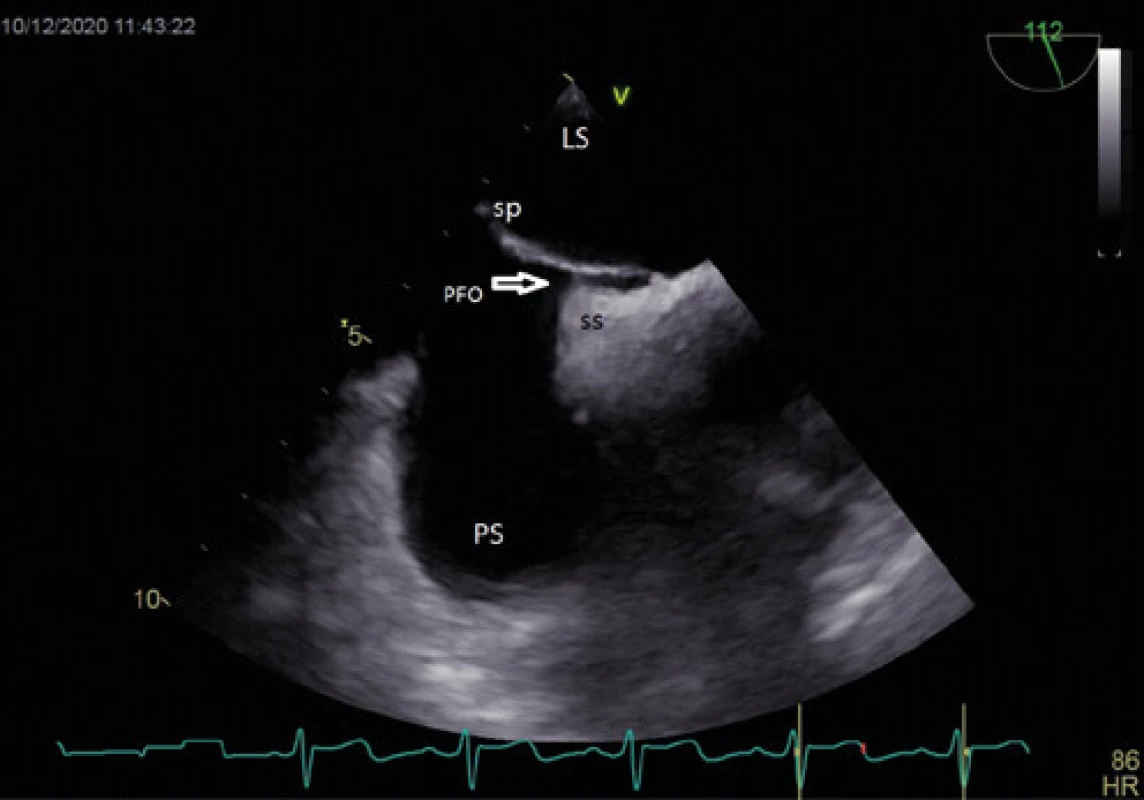 Patentní foramen ovale – TEE