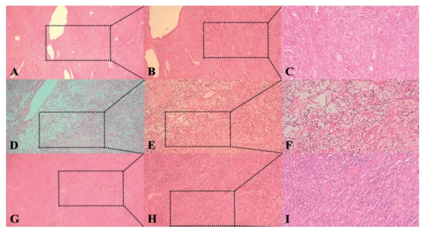 Histologické nálezy tumorov jednotlivých pacientov<br>
Fig. 4: Histological findings of tumors of individual patients