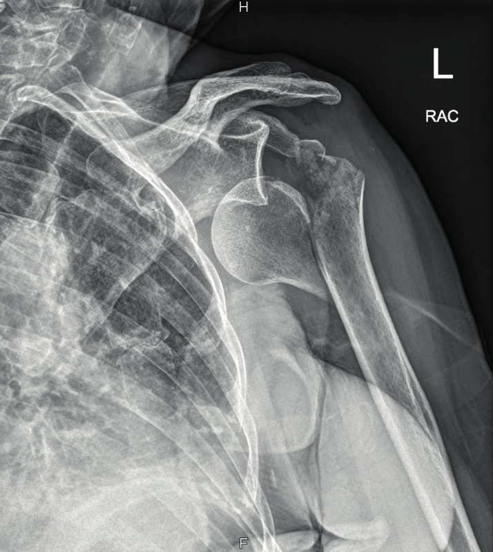 Comminutive tuberosity fracture with humeral head dislocation
and metaphyseal fracture on X-ray image