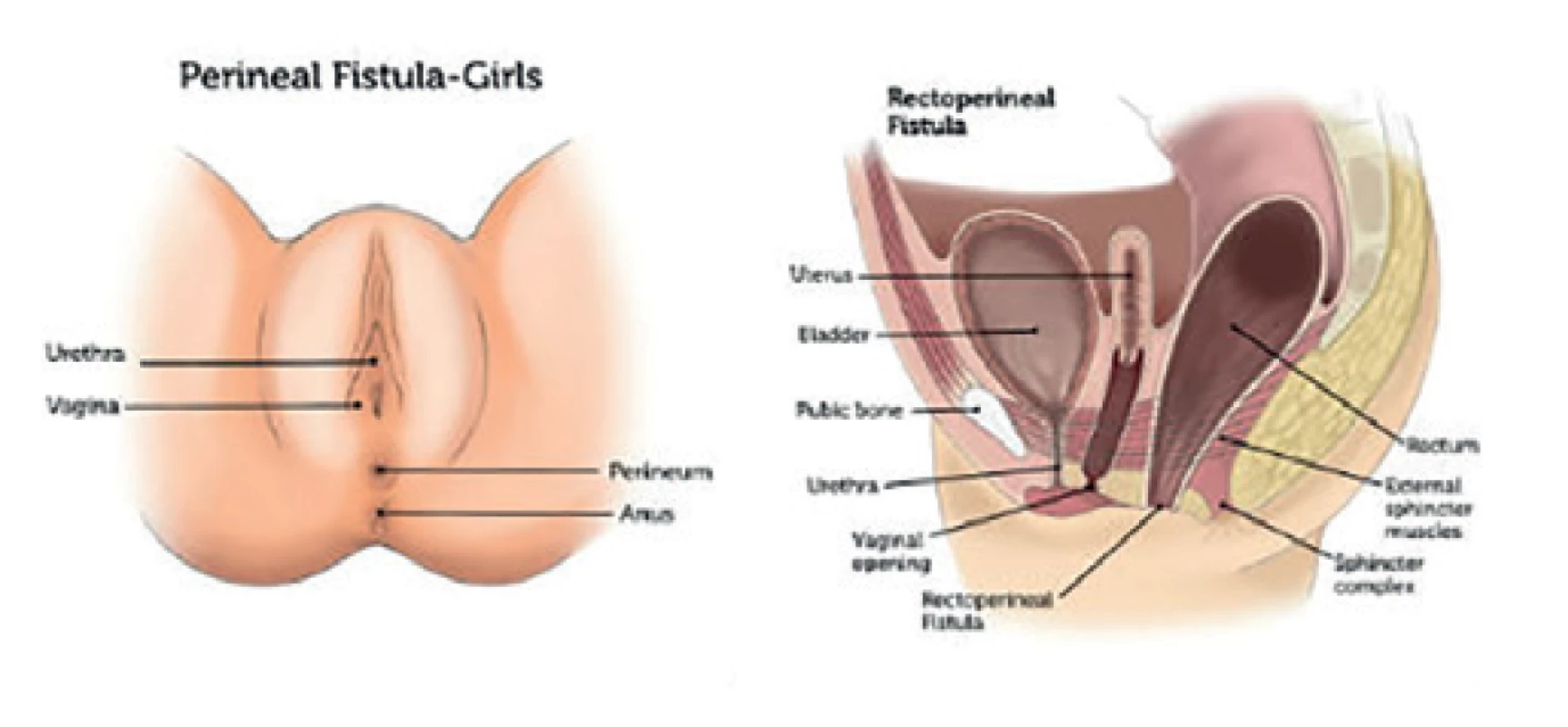 Anus perinei ventralis u dívek
(dostupné z https://www.childrenshospital.org/conditions-
-and-treatments/conditions/a/anorectal-malformation)<br>
Fig. 1: Anus perinei ventralis in girl
(available at https://www.childrenshospital.org/conditions-
-and-treatments/conditions/a/anorectal-malformation)