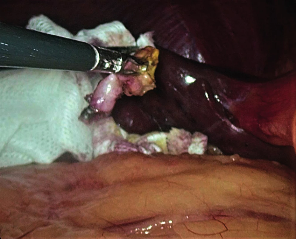 Extirpated organ at the end of the laparoscopic
cholecystectomy