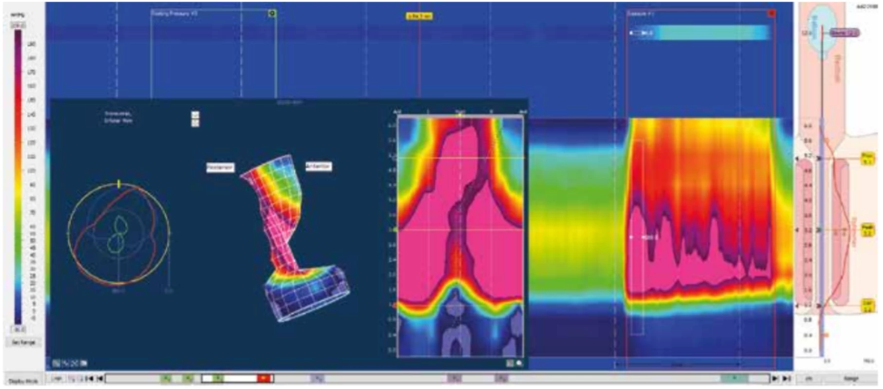 Normální nález – sevření
Vlevo 3D model tlakových poměrů análního kanálu při maximálním sevření, pootočen o 90°. Při sevření se ozřejmuje utažení smyčky m. puborectalis (proximálně v zadní části) a sevření externích svěračů (distálně).
Zdroj: Archiv oddělení gastrointestinální endoskopie, Ústřední vojenská nemocnice − Vojenská fakultní nemocnice, Praha. <br>
Fig. 2: Normal finding – squeeze maneuver
On the left, a 3D model of the pressure conditions of the anal canal at maximum squeeze, rotated by 90 °. When squeezed, the
tightening of the puborectalis loop (proximally in the posterior part) and the tightening of the external sphincters (distal) become
clear. Source: Department of Gastrointestinal Endoscopy Archive, Military University Hospital, Prague.