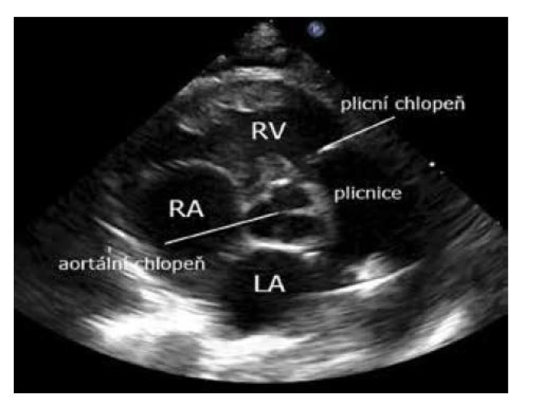 Parasternální krátká osa – aorta