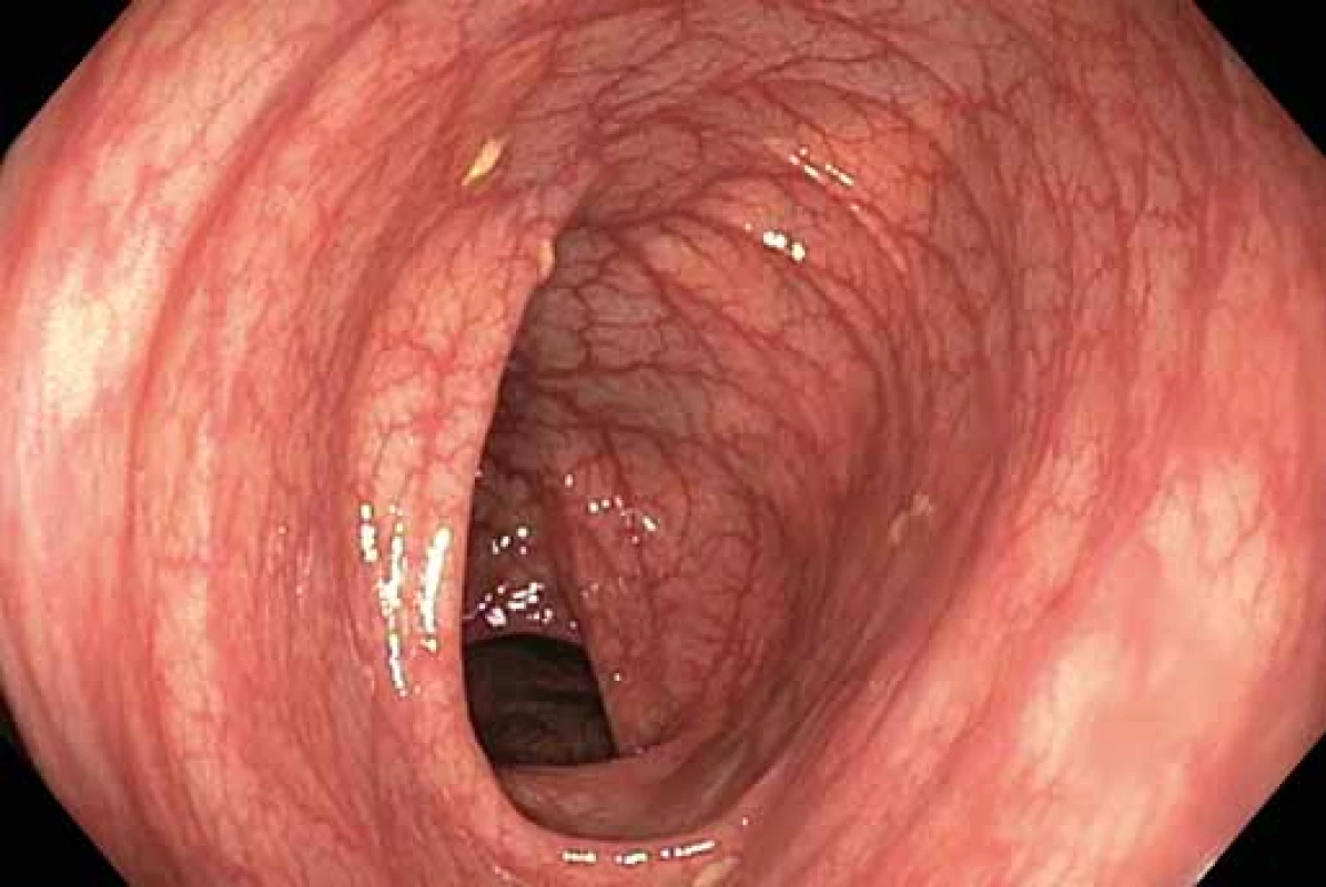 Stupeň střevní přípravy A. Zdroj: Archiv oddělení
gastrointestinální endoskopie, ÚVN VFN, Praha.<br>
Fig. 1. Degree of intestinal preparation A. Source: Archive
department of gastrointestinal endoscopy, ÚVN Military
university hospital, Prague.
