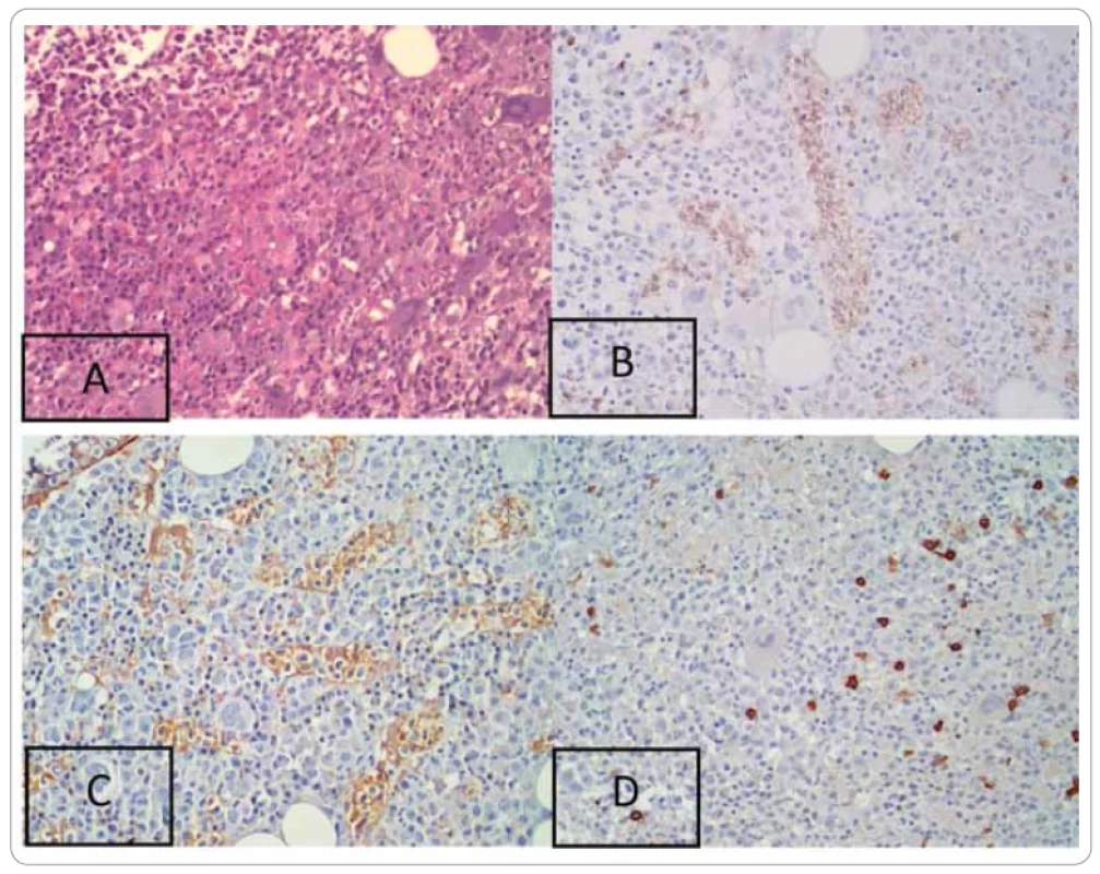(A) Bone marrow trephine biopsy showed monotonous lymphocytes with medium-size nuclei arranged in cords that were
sometimes diffi cult to be assessed using hematoxylin-eosin staining (400×). (B) Immunohistochemistry staining showed positive
CD3 in neoplastic cells in sinusoids (400×). (C) CD56 was also positive in neoplastic cells in the sinusoids (400×). (D) CD20 staining
was negative (400×).