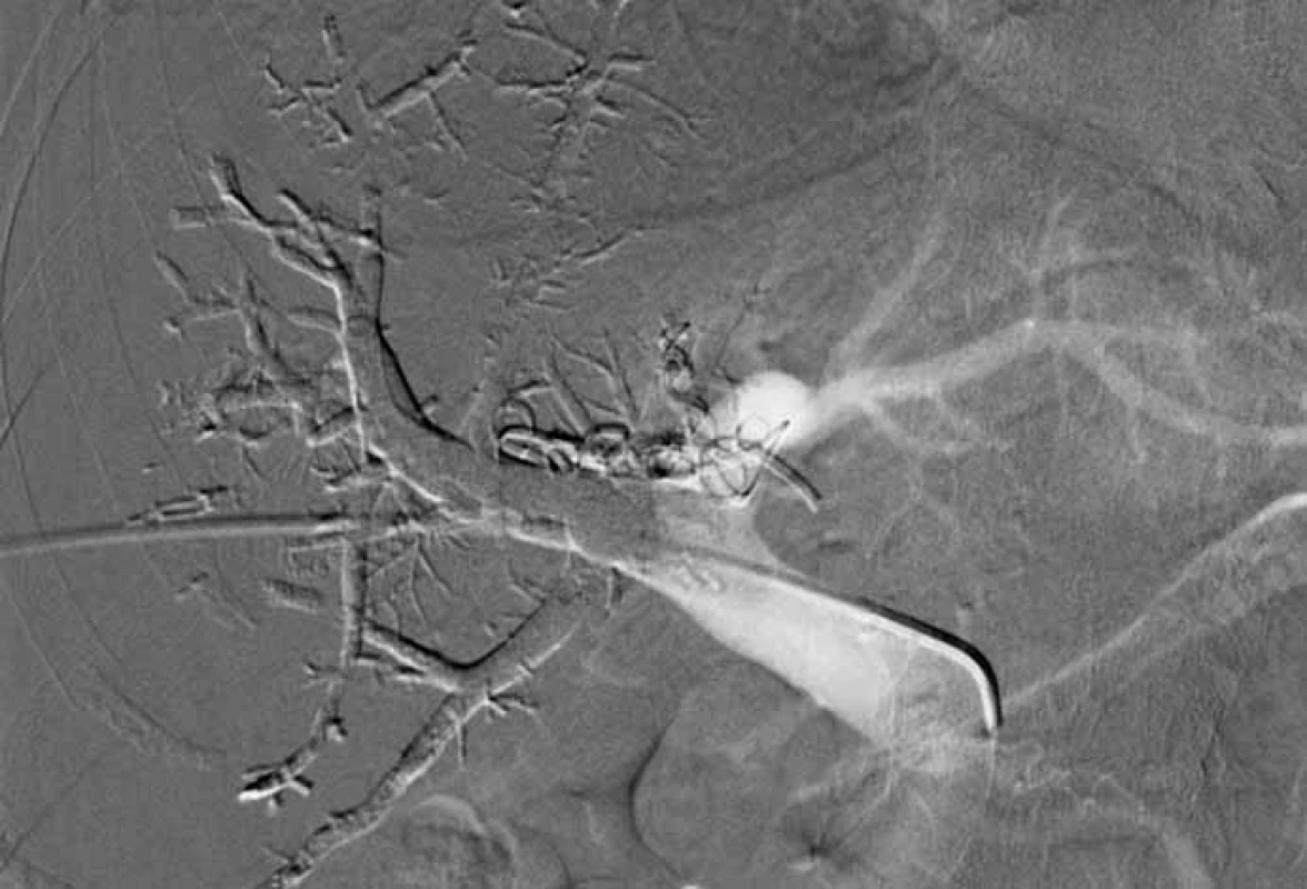 Portální venózní embolizace.<br>
Fig. 1. Portal venous embolisation.