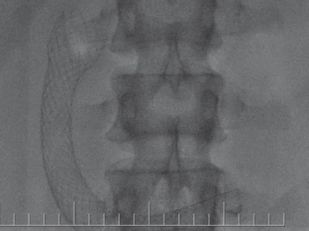 RTG obraz umiestnenia duodenálneho stentu. Zdroj: Archív FN Trnava.<br>
Fig. 3. X-ray image to check the placement of the duodenal stent.
Source: Archive FN Trnava.