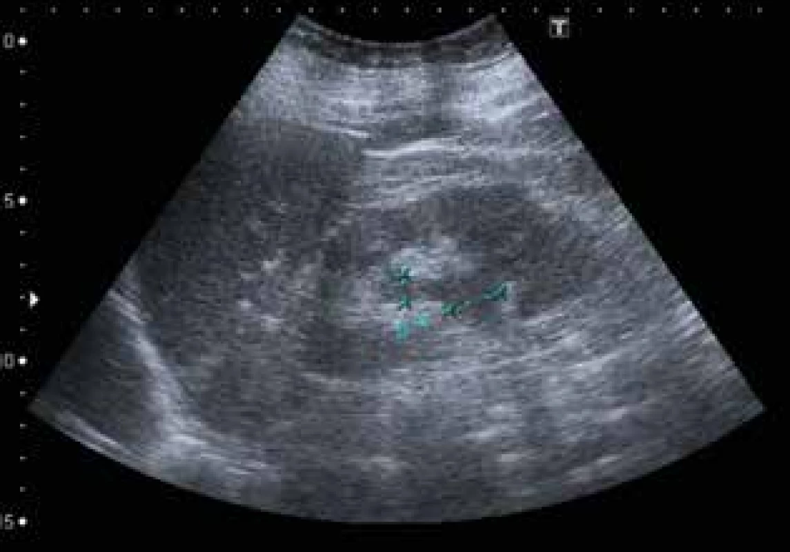 Uroteliální karcinom pánvičky levé ledviny – sonografické vyšetření <br>
Fig. 4: Urothelial carcinoma of the renal pelvis of the left
kidney − ultrasonography