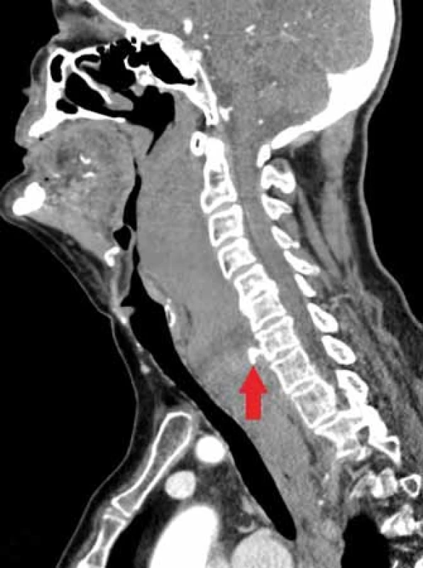 CT sagitální řez ukazuje rozsáhlý
hematom a únik kontrastní látky v místě
aktivního krvácení v úrovni C7 (šipka).<br>
Fig. 1. CT sagittal scan showing massive
haematoma with a contrast leak in the site
of active bleeding at the level C7 (arrow).