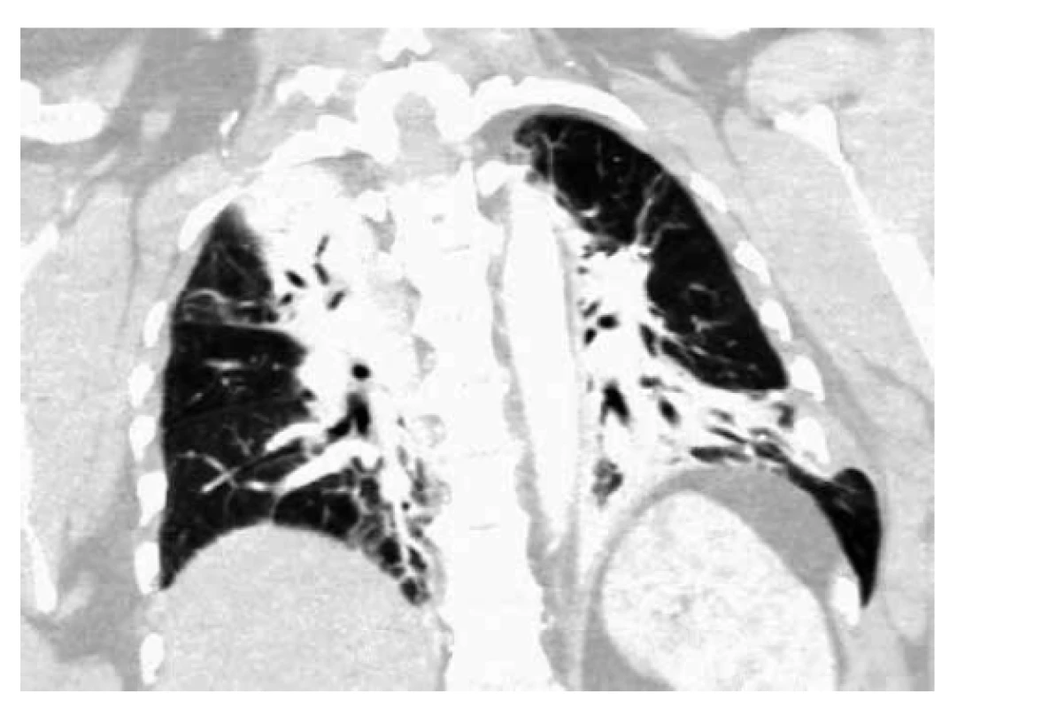 Vstupní CT vyšetření hrudníku<br>
Fig. 2: Initial CT examination of the chest