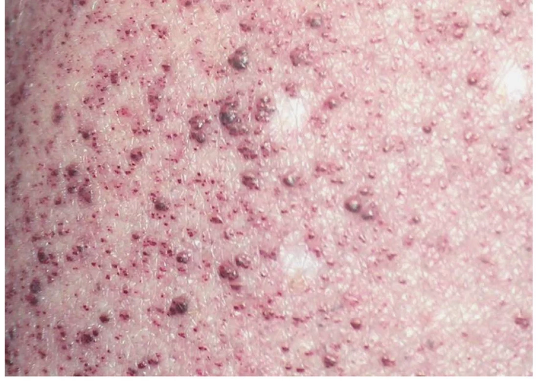 Angiokeratomy kůže u 10letého chlapce s Fabryho
nemocí.<br>
Fig. 8. Angiokeratomas in 10-year-old boy with Fabry
disease.