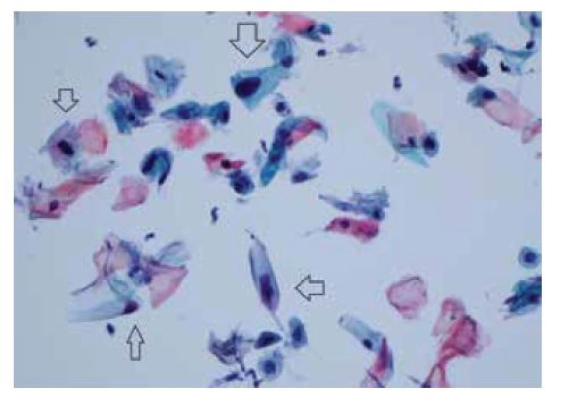 LSIL (low-grade skvamózní intraepiteliální léze) –
anální cytologické nátěry LBC (liquid-based cytology) diagnostikované
jako LSIL obsahují velké dysplastické buňky
skvamózního původu vykazující znaky odpovídající infekci
HPV (šipky)<br>
(barvení podle Papanicolaou, zvětšení 400x)