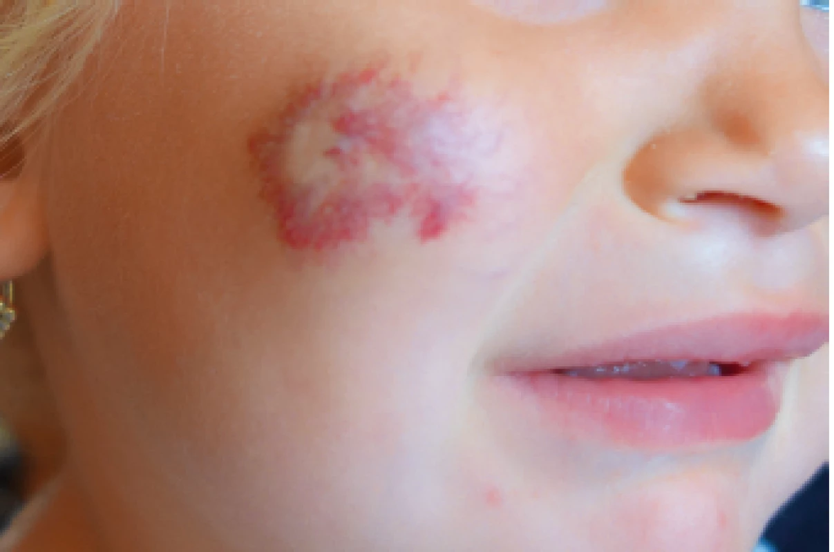 Hypopigmentace a teleangiektázie po involuci IH.<br>
Hypopigmentation and telangiectasia after IH involution.