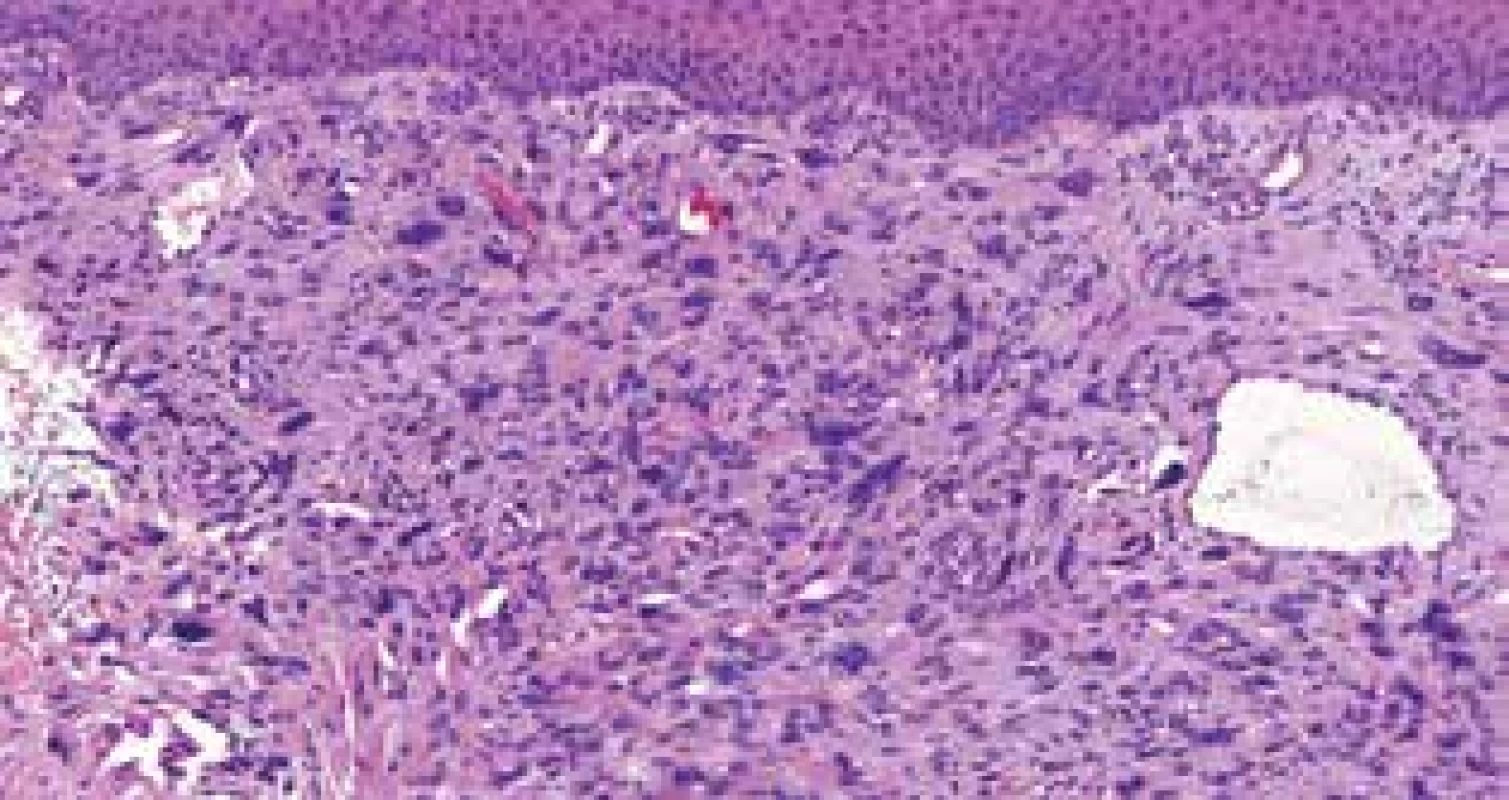 Tumor byl predominantně tvořen pleomorfní vřetenobuněčnou proliferací s bizarními jadernými atypiemi (hematoxylin-eosin, 150krát)
