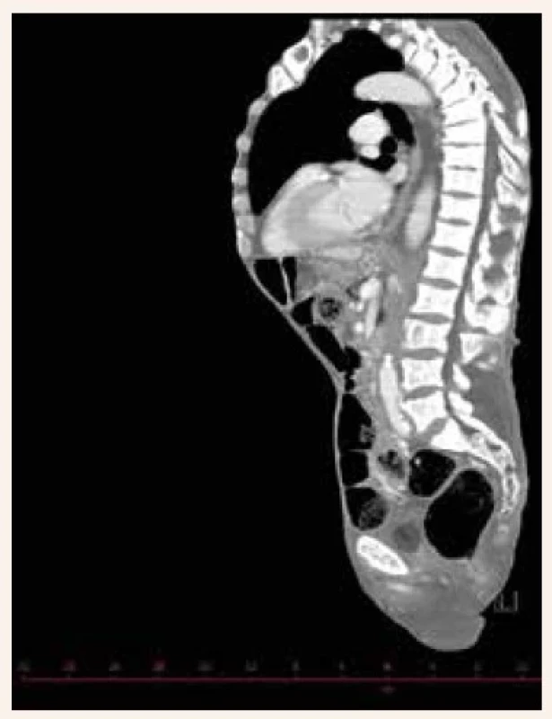 CT-nález mnohočetného postižení skeletu
u pacienta s malabsorpční osteomalacií při
chronické pankreatitidě.