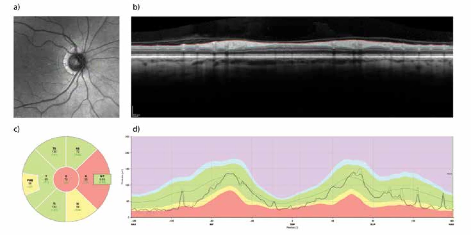 . Retinální vrstva neurálních vláken (RNFL) měřena pomocí optické koherenční tomografie (OCT). Příklad vyšet- ření sítnice pravého oka před chirurgickou dekompresí chiasmatu u 65-ti leté ženy. Měření tzv. peripapilární RNFL probíhá
podél zelené kružnice (a). Profil vrstev sítnice v naznačené trajektorii je na panelu (b), kde je také znázorněno ohraničení
vnitřní limitující membrány a rozhraní mezi vrstvou axonálních vláken a těly gangliových buněk sítnice. Rozdíl mezi oběma
profily tvoří tloušťku peripapilární RNFL a je znázorněn na panelu (d) jako silnější čára probíhající v zeleném pásu znázor- ňujícím normální hodnoty pro danou věkovou skupinu. Průměrné a normativní hodnoty tloušťky RNFL v nazálním a tem- porálním kvadrantu a jejich superiorních a inferiorních částech společně s globální hodnotou jsou znázorněny v panelu (c).
Nazálním kvadrant vykazuje sníženou tloušťku RNFL jako následek komprese zkřížených vláken optického nervu