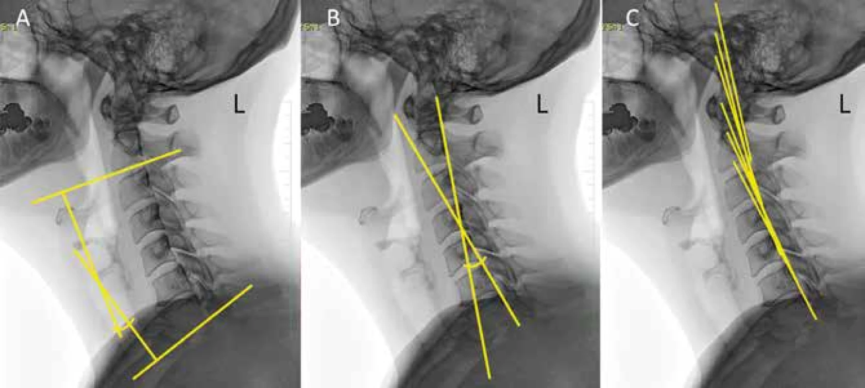 Měření krční lordózy – A Cobbův úhel, B Jacksonův úhel, C Harrisonova tangenciální metoda<br>
Fig. 1: Measurement of the cervical lordosis – A Cobb angle, B Jackson angle, C Harrison tangential method