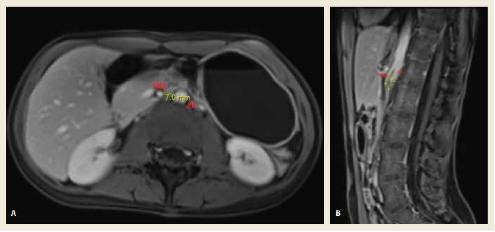 A. MR enterografie (PK T1 VIBE FS, transverzální rovina) s patrným snížením aortomezenterické vzdálenosti na 7 mm.<br>
Obr. 1B. MR enterografie (PK T1 VIBE FS, sagitální rovina) s patrným snížením aortomezenterického úhlu na 14°. <br>
Fig.1A. MR Enterography (PK T1 VIBE FS, axial view) shows the reduction of aortomesenteric distance to 7 mm.
Fig. 1B. MR Enterography (PK T1 VIBE FS, sagittal view) shows the reduction of aortomesenteric angle to 14. 