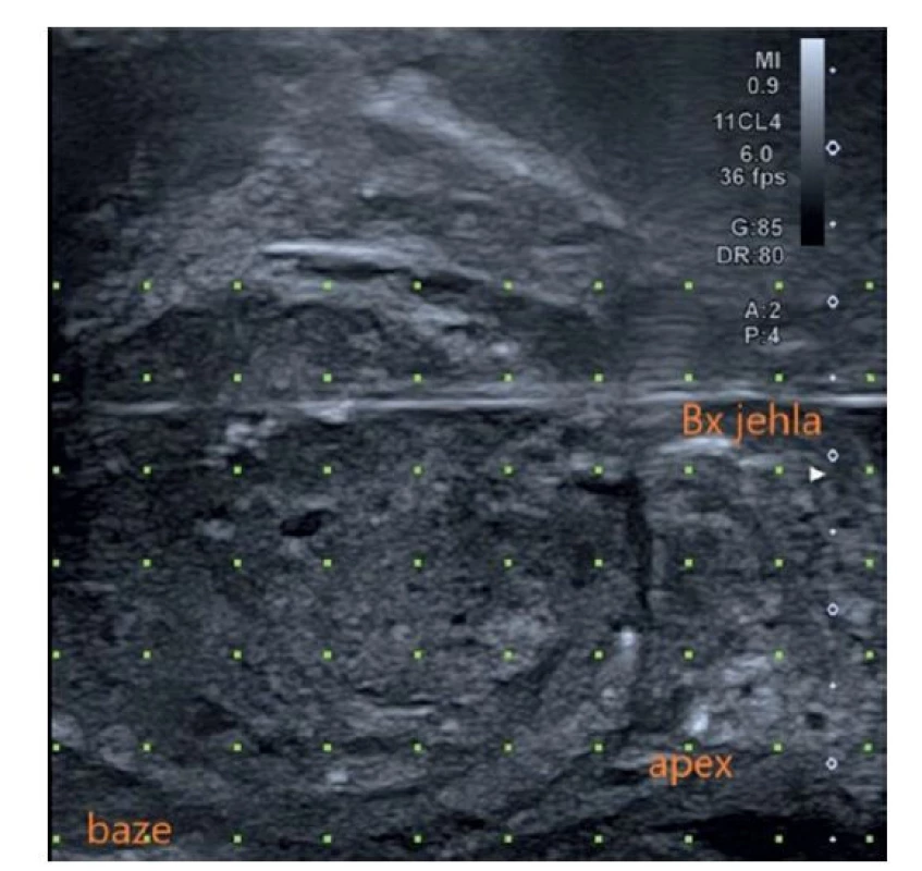 Transrektální ultrasonografie prostaty – sagitální
pohled [61]<br>
Fig. 3. Transrectal ultrasonography of the prostate – sagittal
view [61]