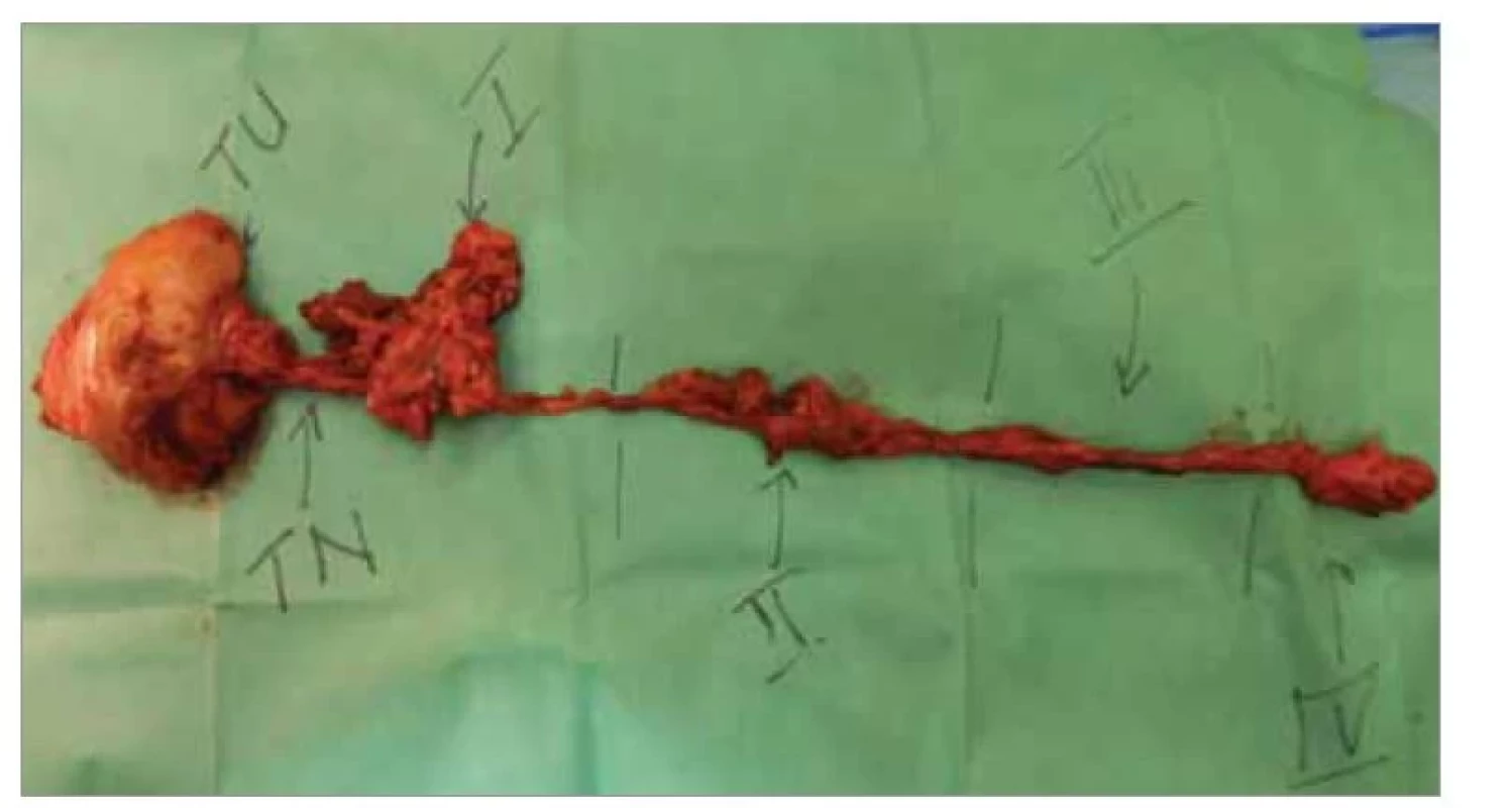 Preparát polovice jazyka s tumorom a blokového disekátu spojených
T-N traktom.<br>
Fig. 5. Specimen of the hemitongue with tumor attached to the neck dissection
specimen by T-N tract.