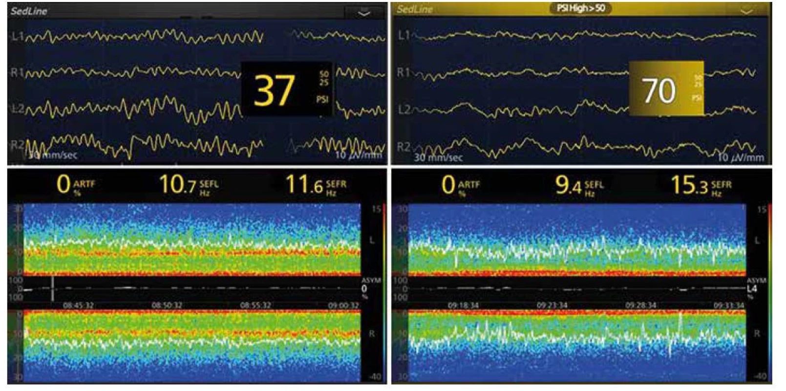 EEG křivky a spektrogramy při doplňované anestezii kombinací sevofluran + sufentanil při ventilaci směsí kyslík + vzduch (vlevo), nebo s 70%
oxidem dusným (vpravo) u 71letého pacienta podstupujícího plastiku a. femoralis
