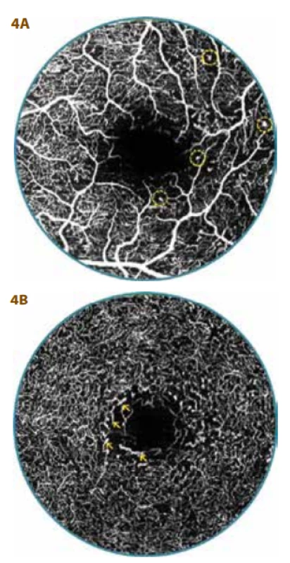 OCT-A examination of 29 year
old diabetic patients (26 year duration
of diabetes) with mild non-proliferative
diabetic retinopathy (DpR)<br>
A. Foveal avascular zone (FAZ) is markedly extended and irregular, superficial vascular complex with multiple zones of non-perfusion, microaneurysms
(in circle) and pronounced overlap of
vascular capillary nodes into FAZ<br>
B. Surface of FAZ – 0.58 mm2, deep vascular complex with numerous zones of
non-perfusion and thinning of capillary
network, with deposits of dilation (arrow)