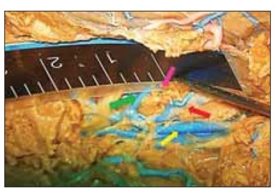Měření šířky koridoru mezi v. thalamostriata
(fialová šipka) a plexus chorioideus
(v. chorioidea superior – červená
šipka) na druhé straně preparátu na základě
srovnání šířky cévního koridoru (lze
odhadnout na 2,5–3 mm) s průměrem zavedené
sondy (1,3 mm). Patrny v. cerebri
internae (žlutá šipka).<br>
Fig. 6. Measurements of the width of the
corridor between the thalamostriatal vein
(violet arrow) and the choroid plexus (superior
choroidal vein – red arrow) on the
second side of the specimen comparing
the width of the vascular corridor (approximately
2.5–3 mm) with the probe
diameter (1.3 mm). Internal cerebral veins
are marked with a yellow arrow.