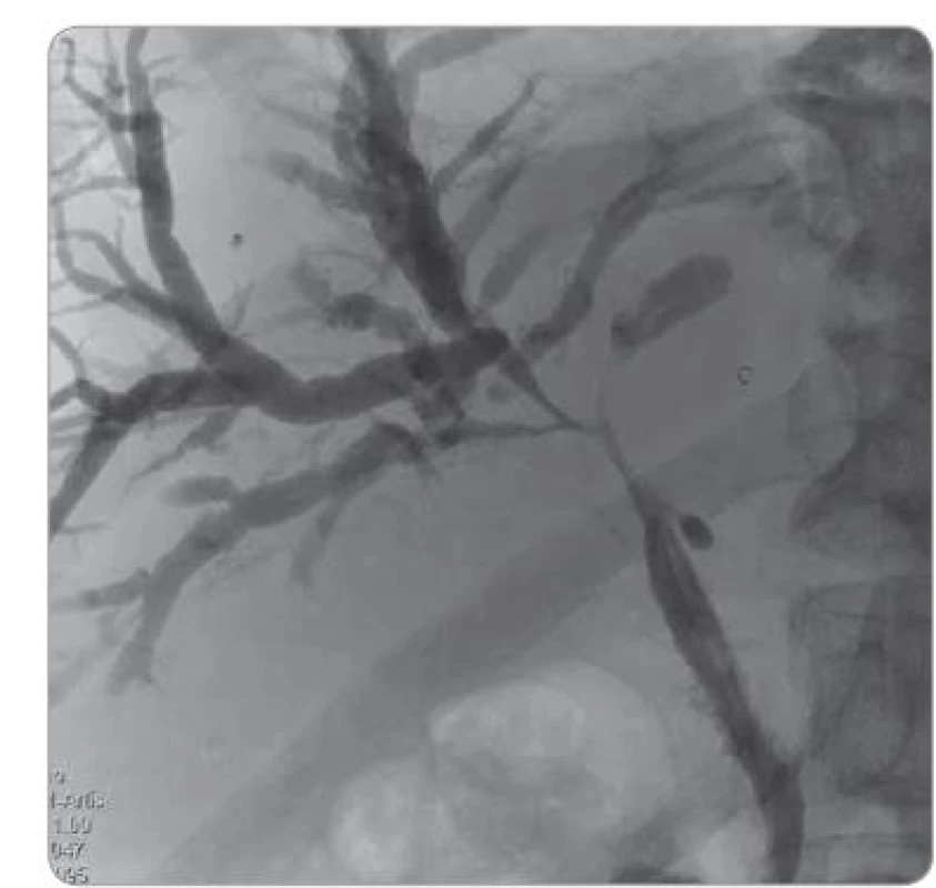 Cholangiografi e – typ IV (stenotizace hilové oblasti).