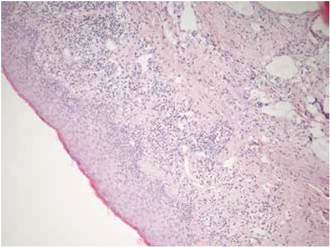 Histologický vzorek z víčkového okraje levého
oka, který odebrán při parciální tarsorafii v roce 2017.
Podobné histologické rysy svědčící pro lichenoidní změny
jako na obrázku 1, s lymfocytární infiltrací subepitelového
pojiva