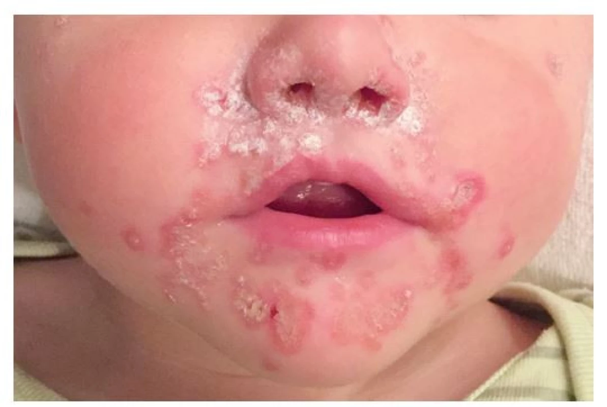 Dvouletý chlapec s impetigem – při stafylokokové rýmě se
rozšířilo z vchodu nosního