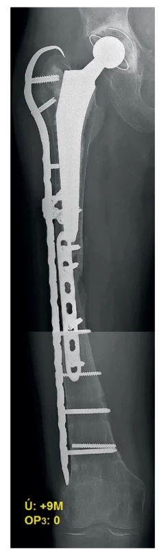 Pooperační RTG – 2. reoperace<br>
Fig. 5: Postoperative X-ray – the 2nd revision surgery