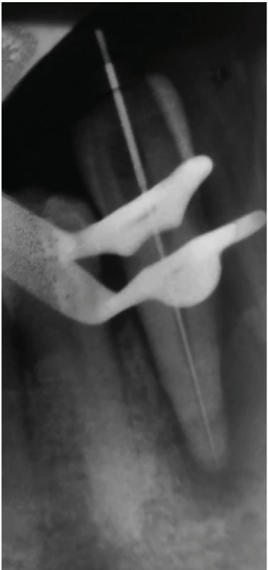 Working length radiograph