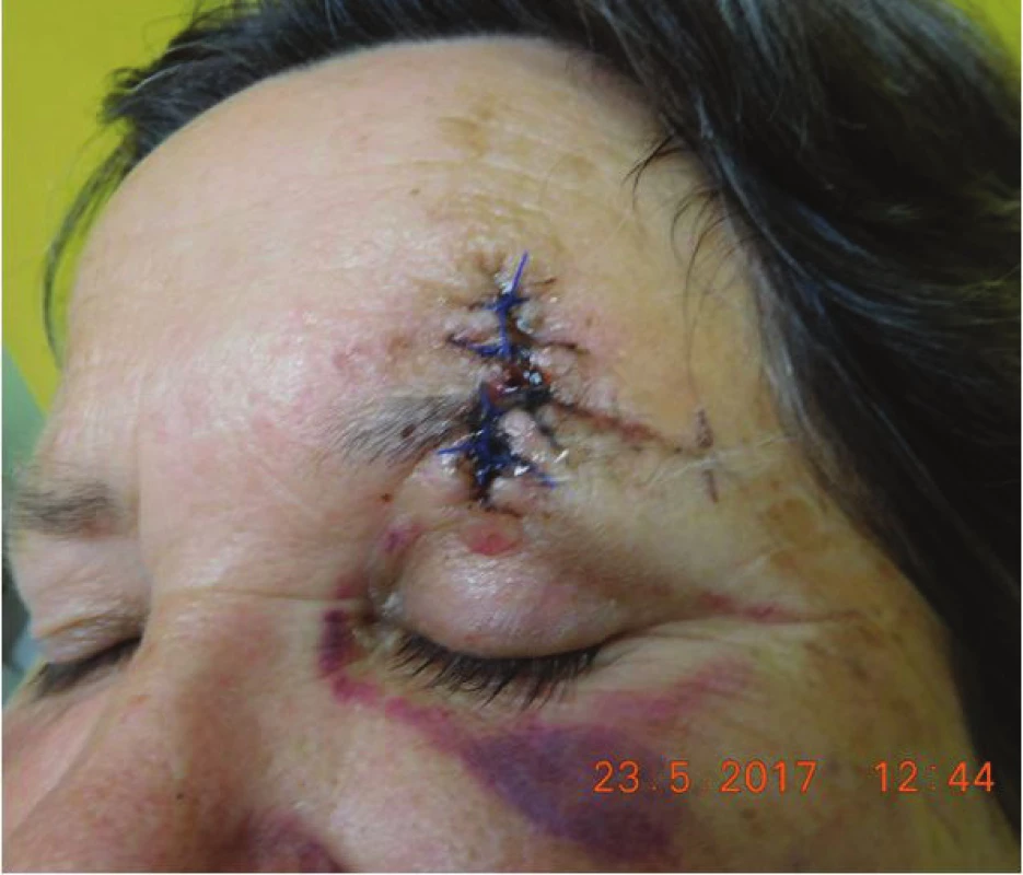 Clinical findings of Patient 2 after surgery in May 2017