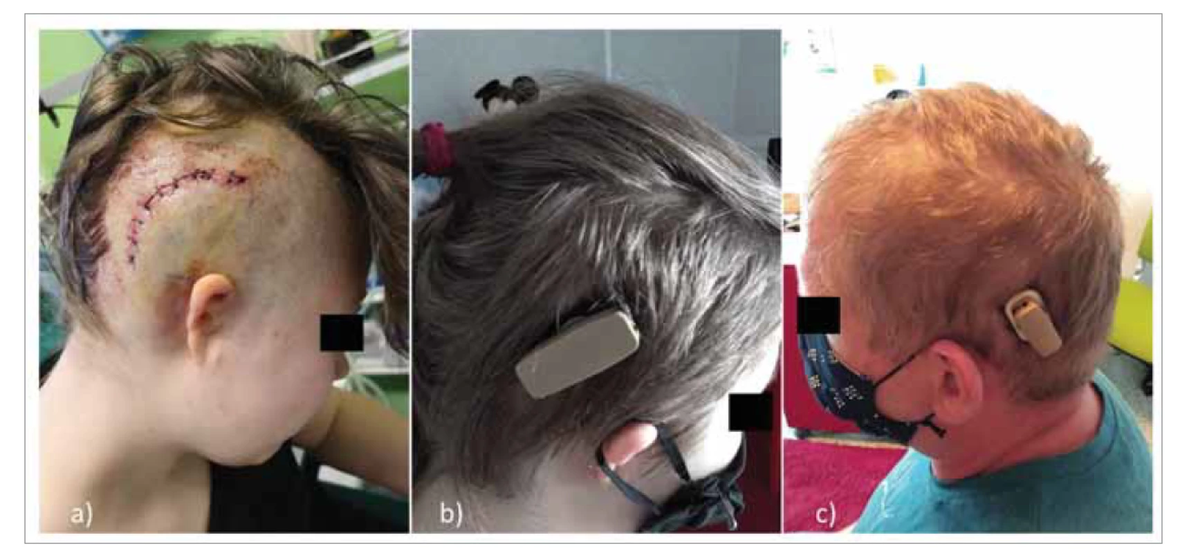 Vzhľad operačnej rany na 1. pooperačný deň (a) a po zhojení a nasadení rečového procesora (b, c).<br>
Fig. 2. Appearance of the surgical wound on the 1st postoperative day (a) and after healing and deployment of the speech
processor (b, c).