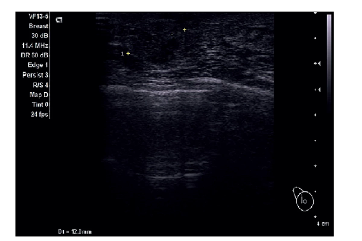 UZ prsu, rezistence v jizvě.<br>
Fig. 6: Ultrasound of the breast, resistance in the scar.