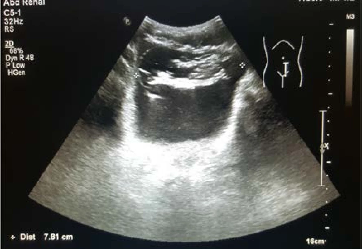 Ultrazvukový obraz cizího předmětu v močovém
měchýři (foto autor MUDr. Petr Kajfosz – KNTB,
a. s., Zlín urologické oddělení)<br>
Fig. 2. An ultrasound image of a foreign body in the
urinary bladder (Photo by Petr Kajfosz, MD – Tomáš
Baťa Regional Hospital in Zlín, Department of Urology)