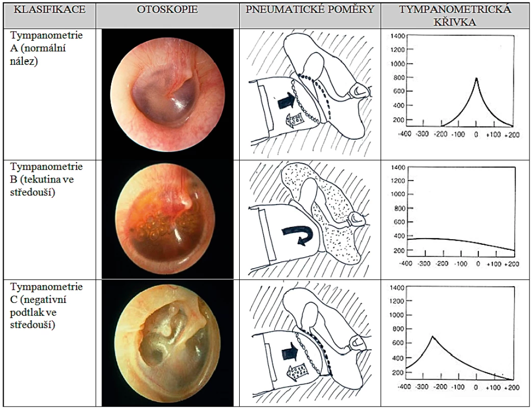 Charakteristika jednotlivých typů otitis media.<br>
(Kresba autora dle Stool SE. Disease of the ear in children with cleft palate and craniofacial anomalies. In: Berkowitz S (ed).
Cleft Lip and Palate. 2nd ed. Berlin: Springer-Verlag Berlin Heidelberg, 2006, Ch.16:355-362, a fotoarchiv MUDr. Horníka)