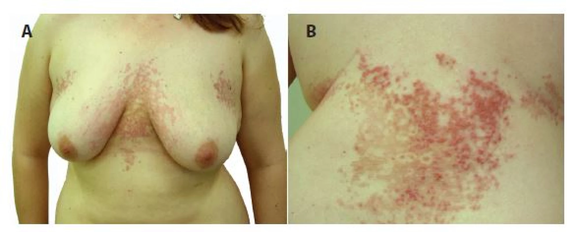 a, b. Prurigo
pigmentosa eytematózní
retikulárně splývající
makulopapuly až papulovezkuly
s krustami
přecházející v hnědé
hyperpigmentace