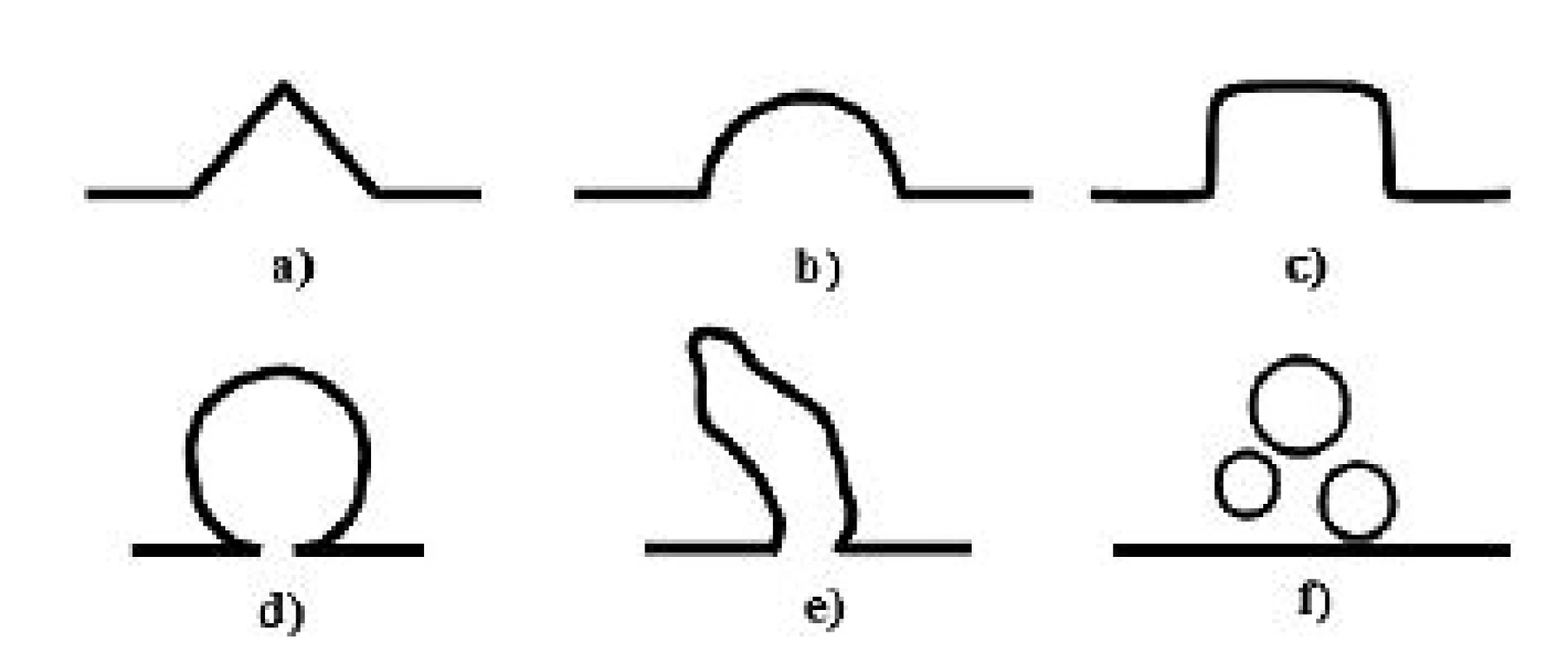 Schematický diagram možných tvarů isthmokély podle
sonohysterografie