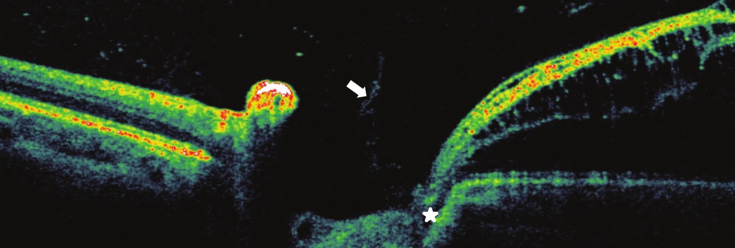 Patient no. 4 Linear horizontal transpapillary OCT scan of LE, interpapillary proliferation (arrow), identified communication of optic disc pit with macular retinoschisis of external layer of retina RSE*