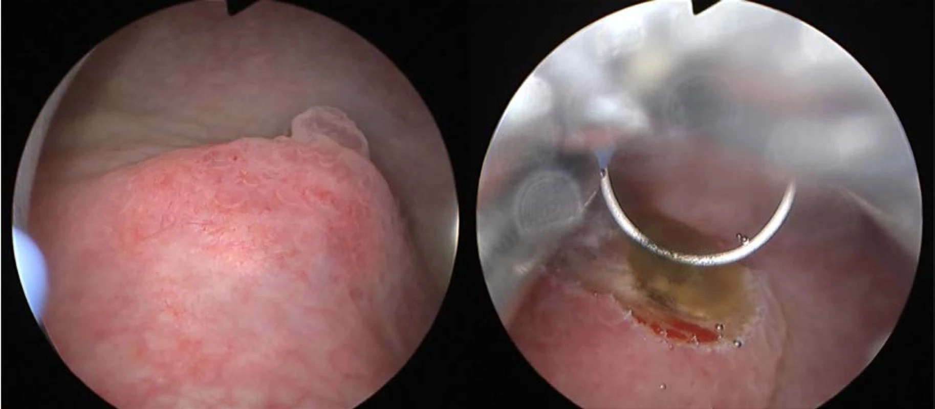 Cystoskopie a TUR biopsie: tumorózní útvar na zadní stěně močového měchýře<br>
Fig. 2. Cystoscopy and TUR biopsy: tumorous formation on the bladder back wall