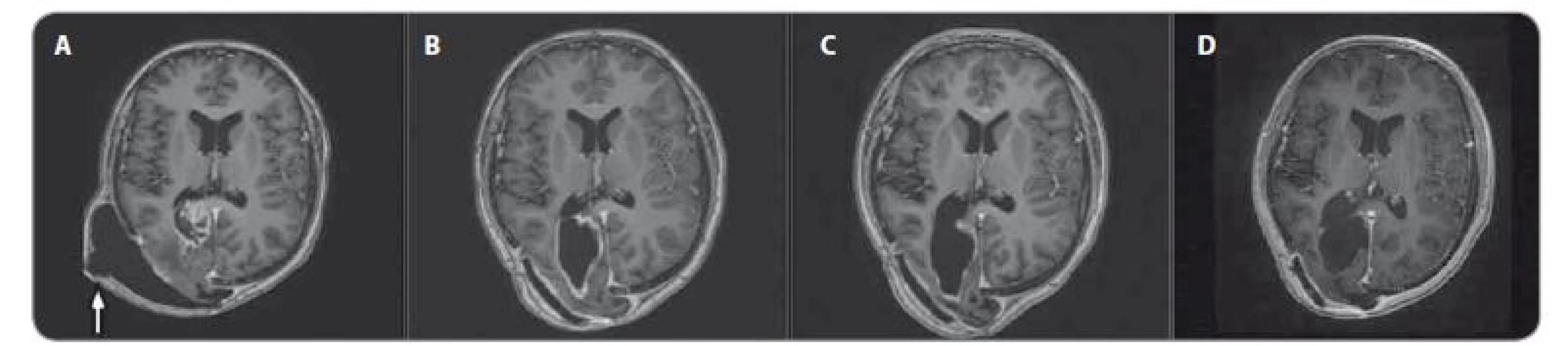 MRI, T1 vážené obrazy s kontrastem – pokračující léčebná odpověď. A) před terapií, B) po 3 měsících, C) po 6 měsících, D) po 15
měsících nivolumabu, bílá šipka označuje pooperační pseudomeningokélu.