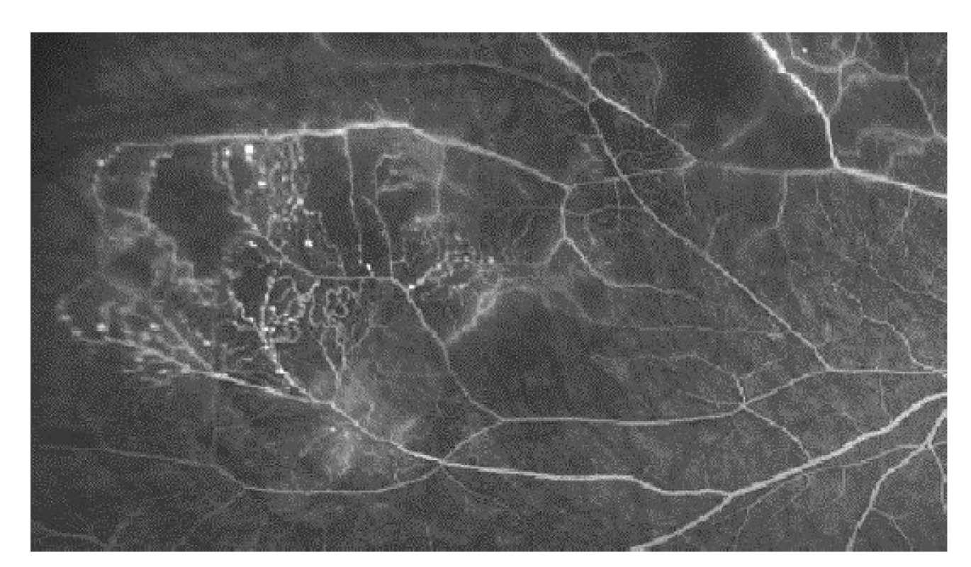 Poradiační cévní změny – mikroaneurysmata a arteriovenozní
zkraty