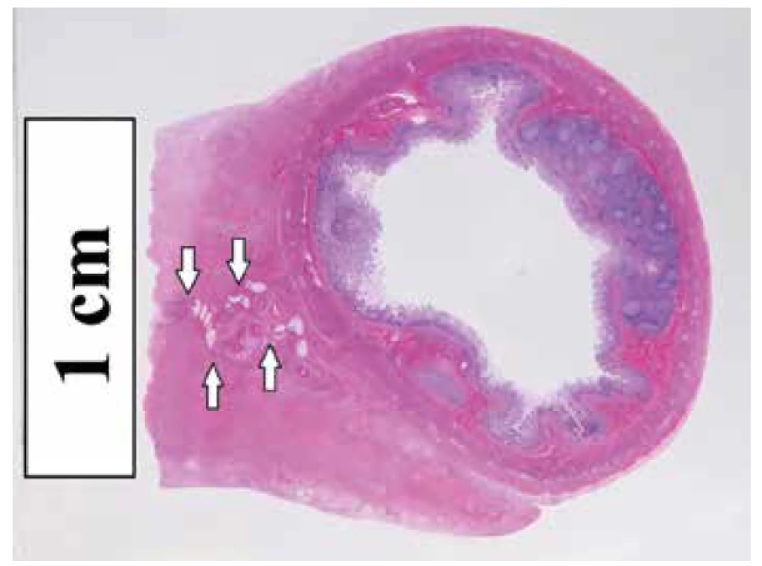 Histotopogram fibrotického zhrubnutia terminálneho mezentéria
s jeho pôvodnými štruktúrami (šípky). Farbenie hematoxylín-eozín.